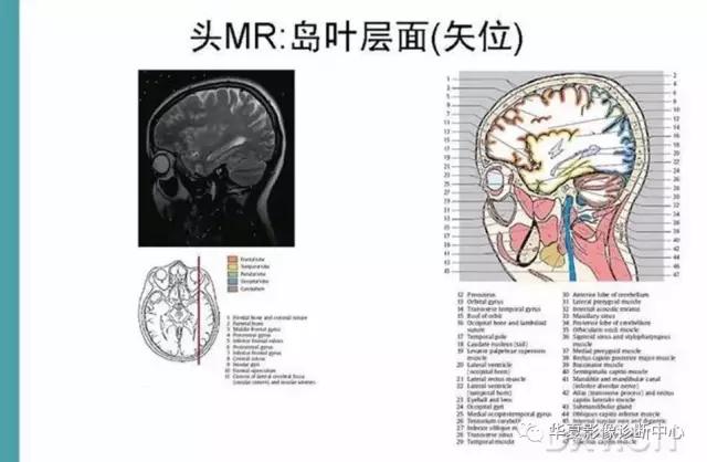 电子版头颅ct与mri断层解剖,头颅mri血管解剖与分段详解