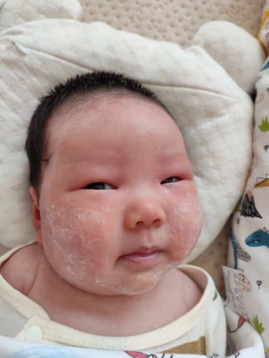 根治湿疹特效药,宝宝湿疹大作战图文