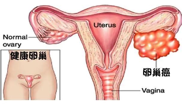 母亲节抗癌经历,母亲节抗癌记录