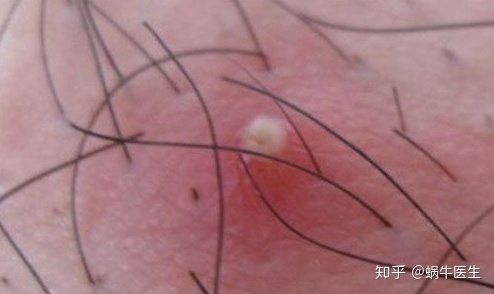 有这几个情况说明你该清理螨虫了,头皮上长小红疙瘩是螨虫导致的吗