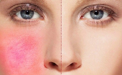 血丝出现原因,血丝红是怎么回事