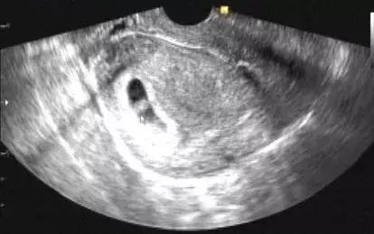 保胎先兆流产要注意什么,先兆流产怎样保胎最快最好