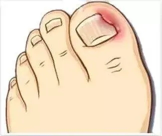 指甲老往肉里长化脓,指甲为什么一直往肉里长