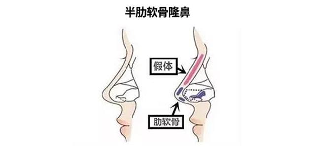 鼻子本身基础好的做隆鼻区别大吗,鼻子更高更立体