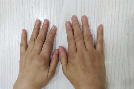 得了类风湿有彻底治愈的案例吗,类风湿治疗要趁早