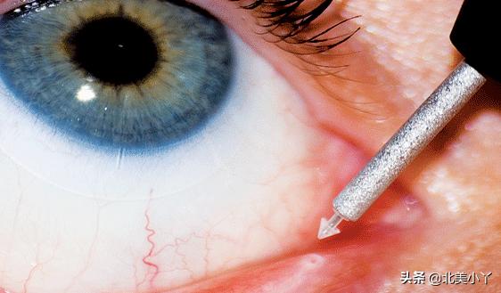 眼科医生3个忠告缓解干眼症,干眼症怎么解决眼科专家来告诉你