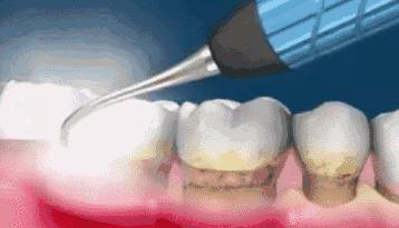 洗牙之后牙缝敏感,洗牙疼不疼