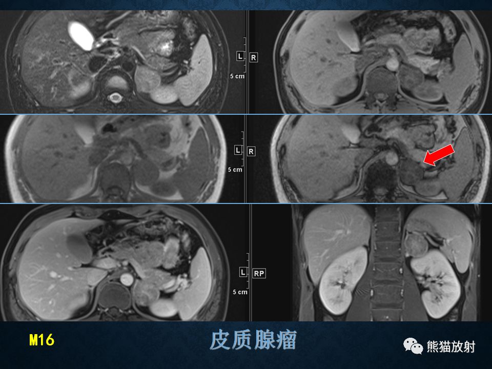 纵隔和肾上腺恶性肿瘤,纵隔性肿瘤位置图