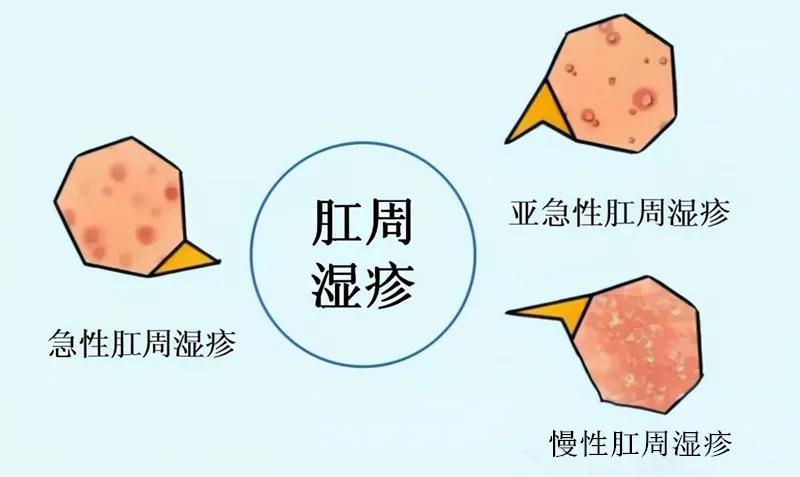 屁股痒痒怎么治,屁股痒痒怎么快速缓解