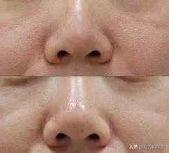 拯救毛孔粗大你不知道方法,脸上毛孔粗大的拯救视频