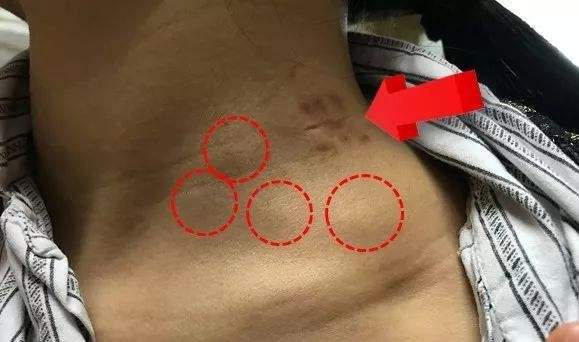 癌症已转移化疗有效吗,癌症有转移还有手术必要吗