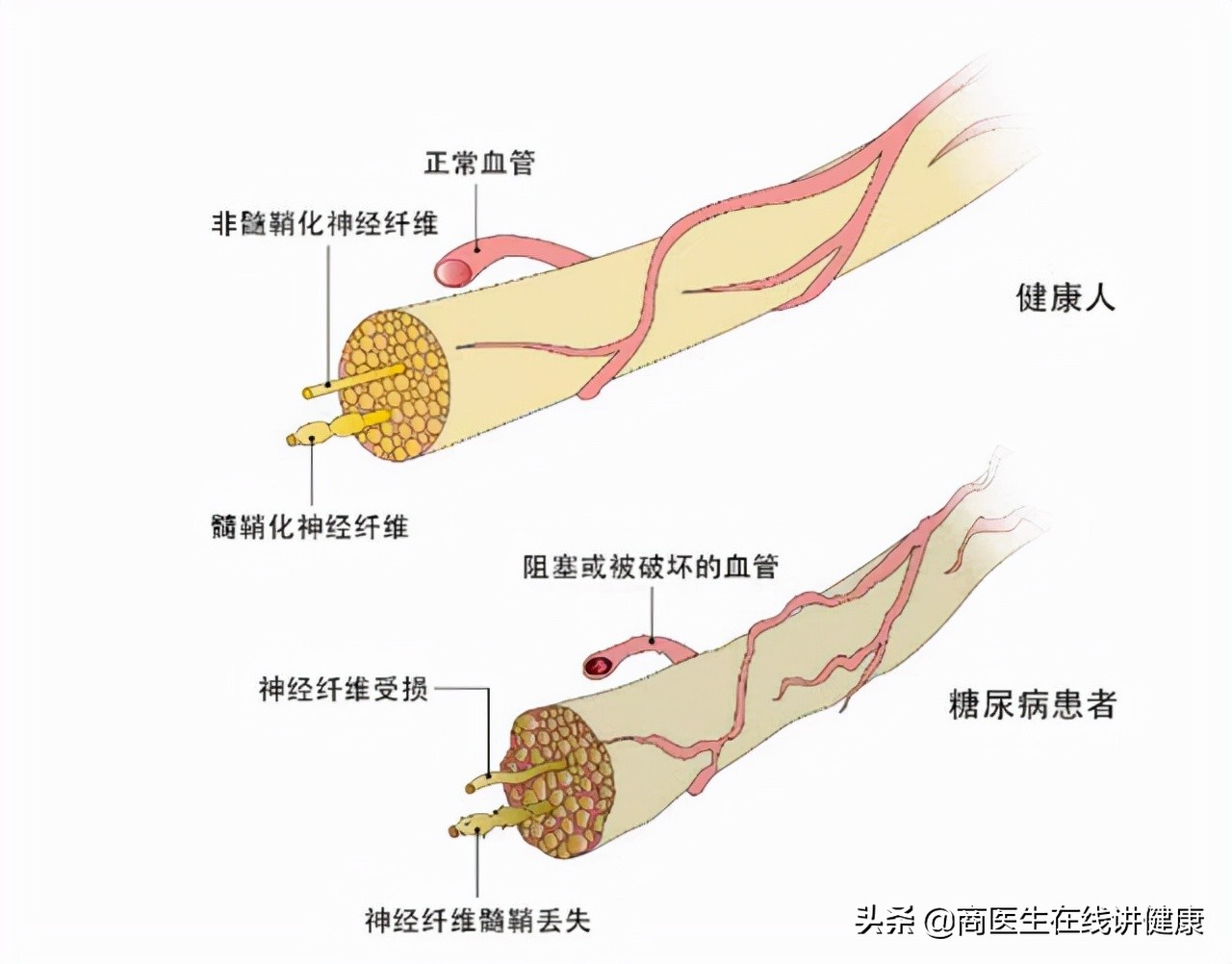 糖尿病伤着肾吃什么药最好,糖尿病损伤神经吃点什么药