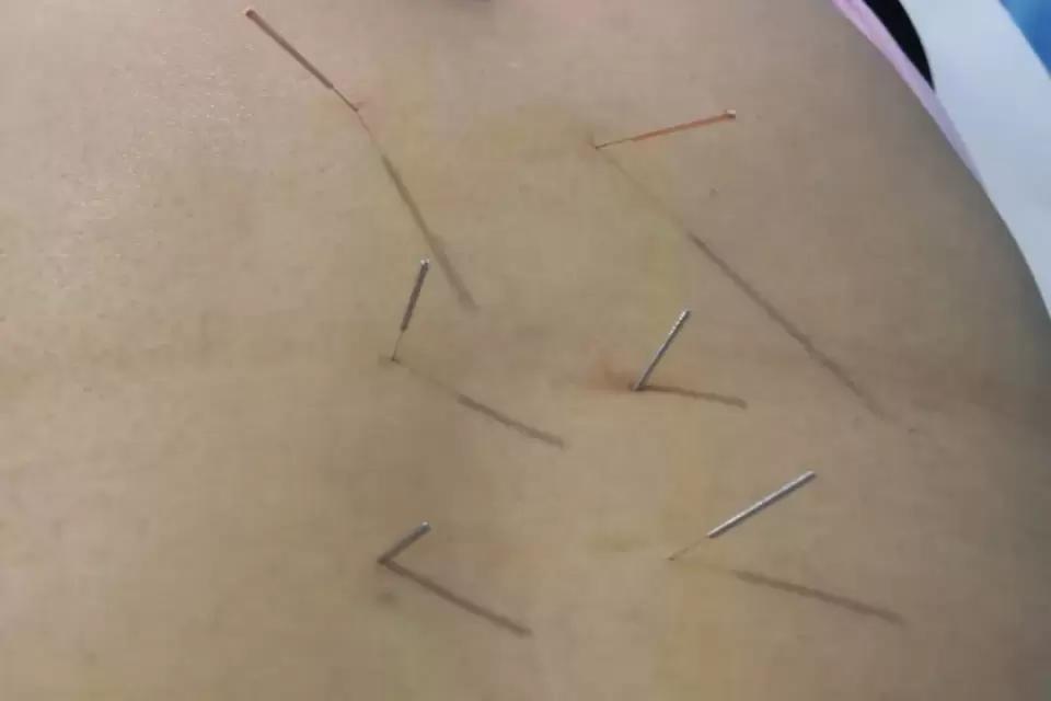 针刺次髎穴,针灸治疗巨髎穴疼痛