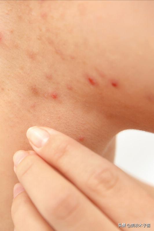 25岁身体各种毛病,20岁皮肤容易出现的问题