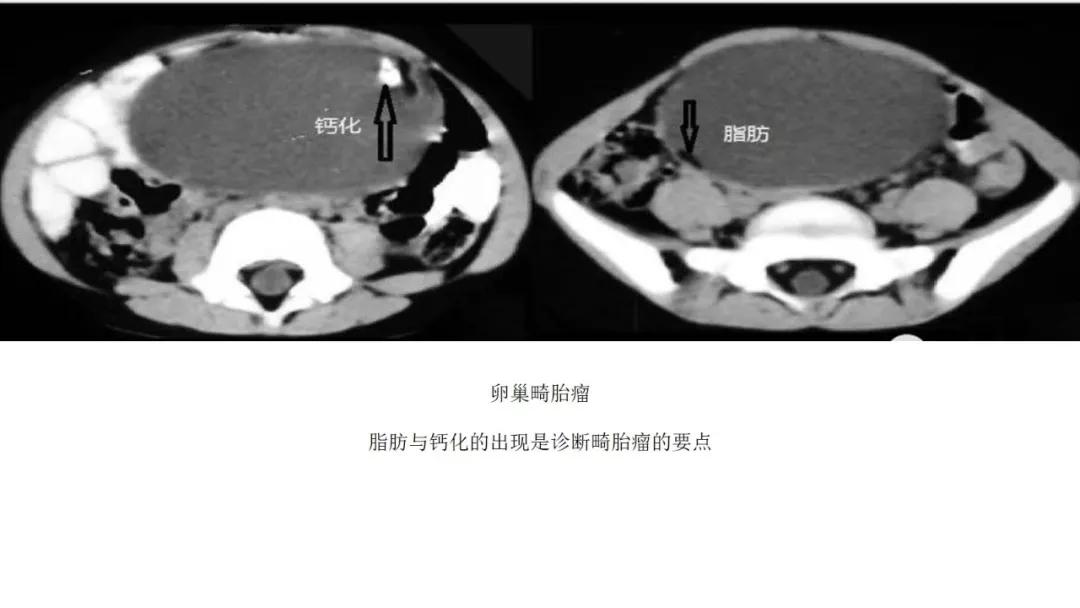 卵巢原发肿瘤的分析思路