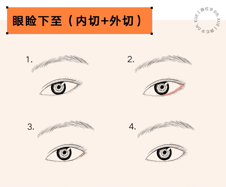 要不要开下眼睑,要不要开内眦赘皮