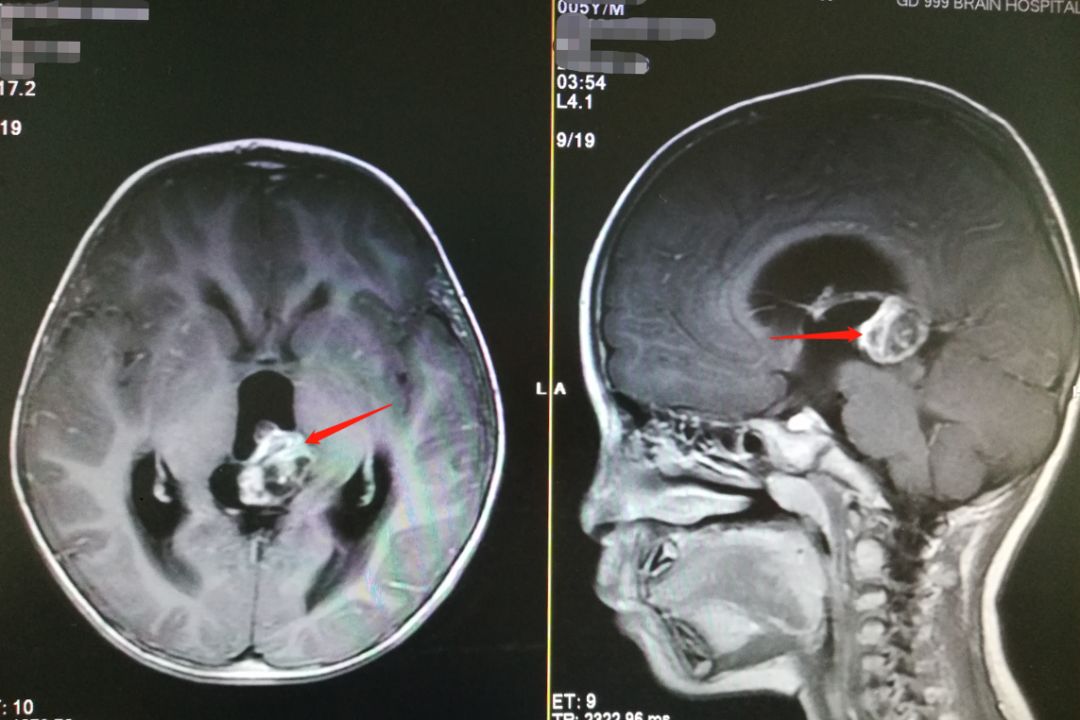 五岁男孩牙齿一长一短,5岁男孩的牙齿居然长在了脑袋里