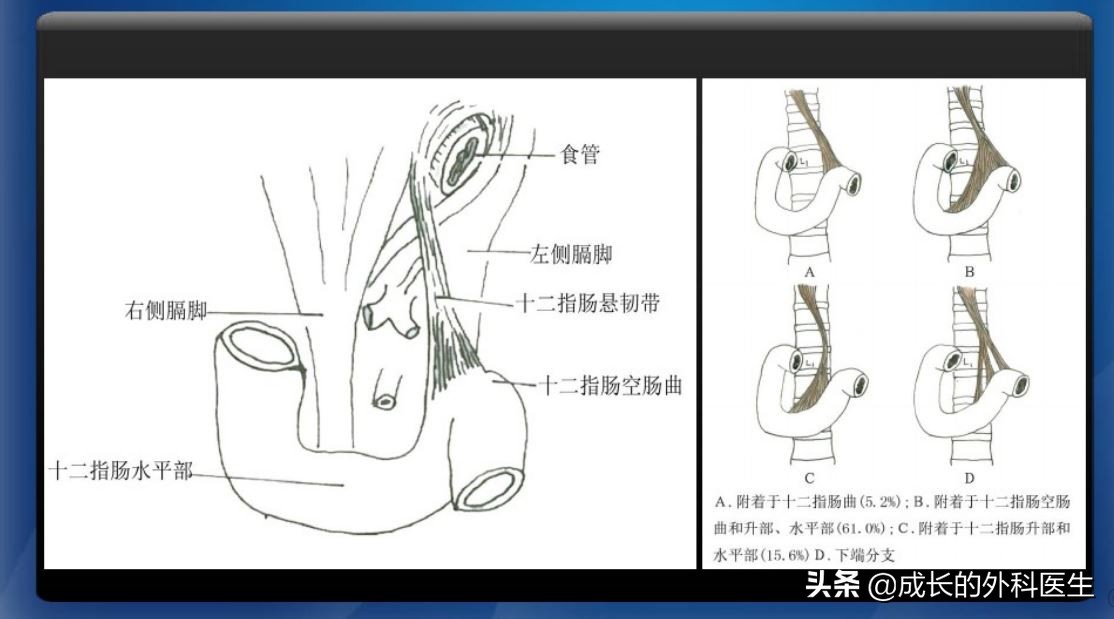 肠系膜上动脉压迫综合征ct表现,儿童肠系膜压迫综合征哪种手术好