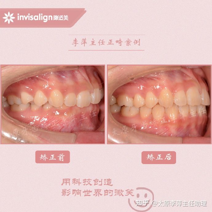 太原矫正牙齿需要做正颌吗,太原牙齿二次矫正