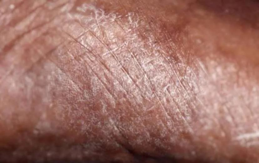 冬天治疗脚气的最快的5种方法,冀连梅抗生素