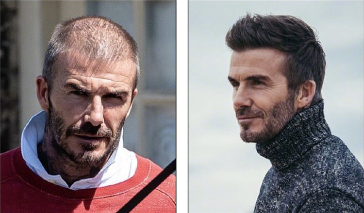 贝克汉姆头秃,贝克汉姆秃了头