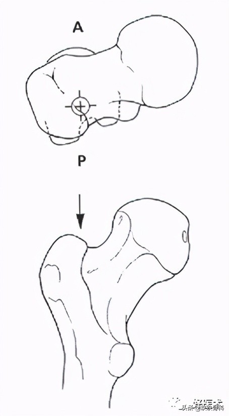 髓内钉技巧,髓内钉教学视频讲解