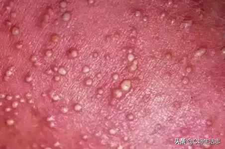 长痱子怎么办小妙招,夏天长痱子有什么食疗方法