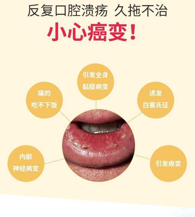 口腔溃疡是否有癌变症状,口腔溃疡的症状和中医治疗方法