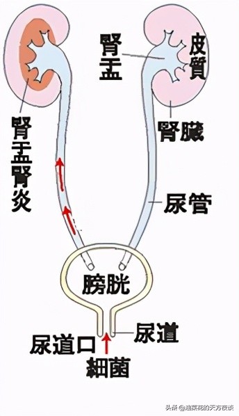 尿路感染别不当回事专家告诉你,尿路感染热淋清有用吗