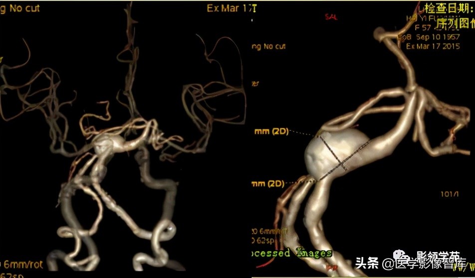 鞍区肿瘤做什么检查得出来,鞍区肿瘤的影像学鉴别