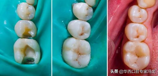 牙齿龋坏补牙多少钱,门牙龋坏了建议补牙还是做牙冠