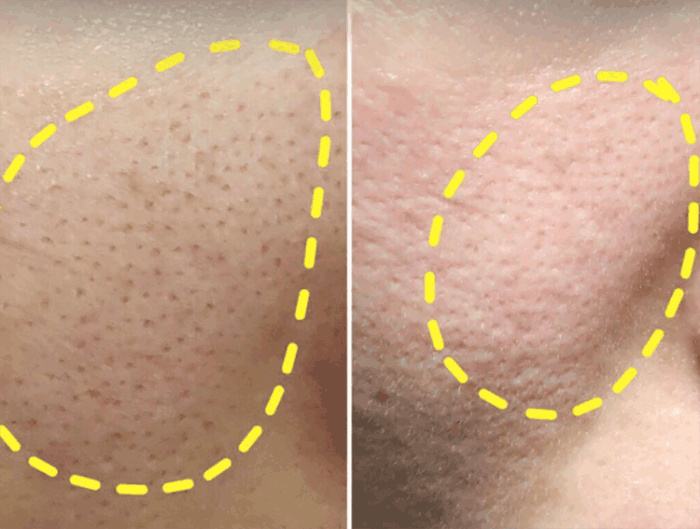 毛孔粗大怎么办教你一招根除,毛孔粗大怎么让毛孔变得细腻