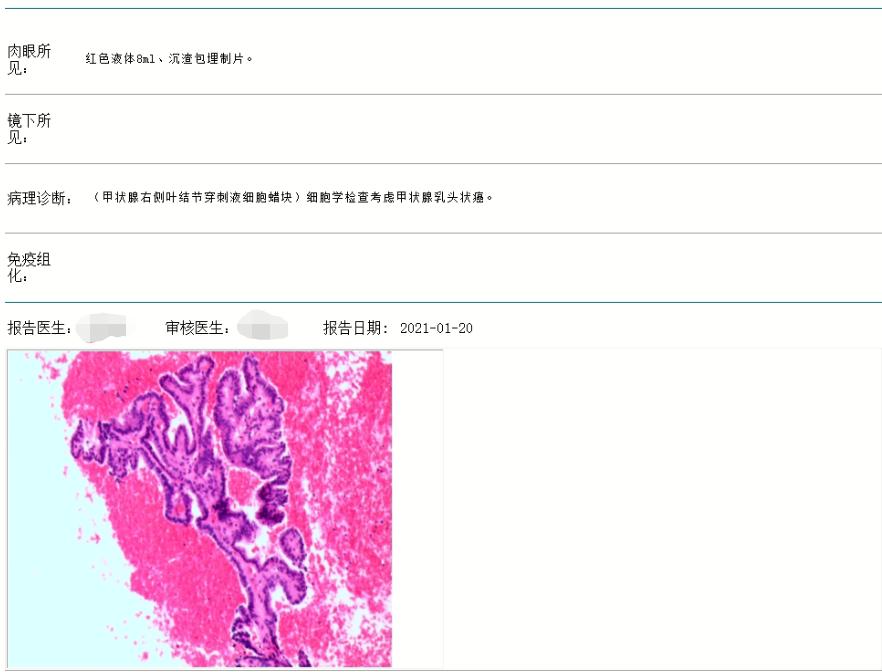 甲状腺右残叶再发3.5毫米（芝麻粒大小）结节，何去何从？