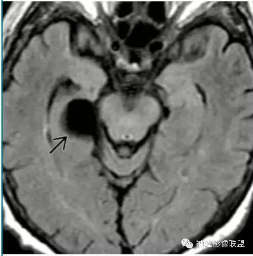 各种囊肿的症状,颅内囊肿18-19mm严重吗