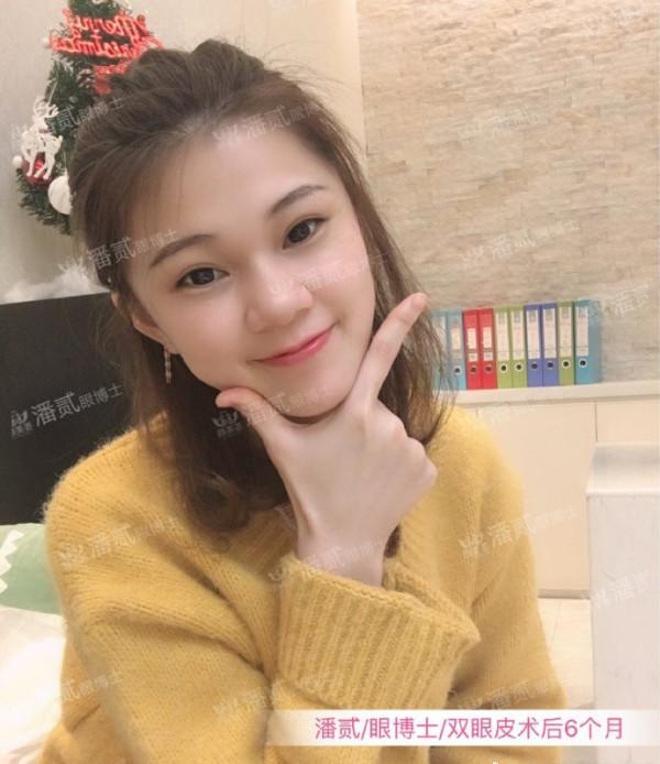 什么样的肿眼泡适合全切,什么样的肿眼泡不用动提肌