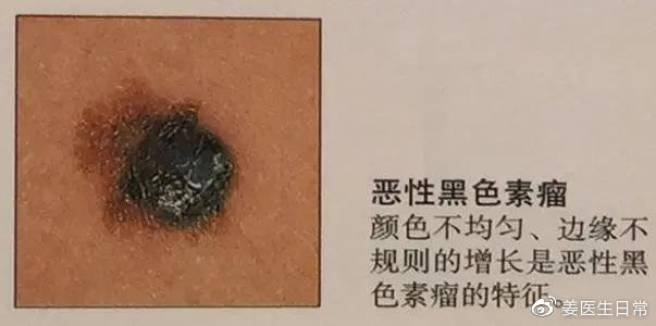 脸上长痣越来越多怎么回事,想把脸上的痣去掉去医院哪个科