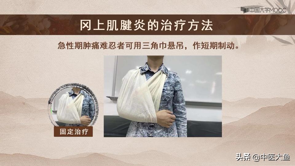 冈上肌腱炎的体征,冈上肌肌腱炎的症状及治疗