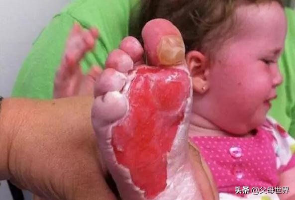 孩子烫伤的紧急处理四大步骤,孩子烫伤“五步”急救法