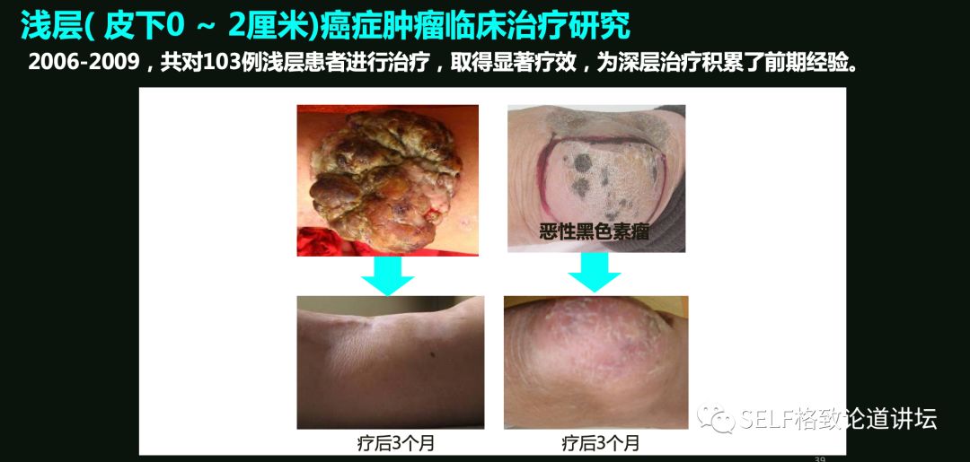 这个装置成功辅助我国两弹爆炸，现在它能治疗肿瘤