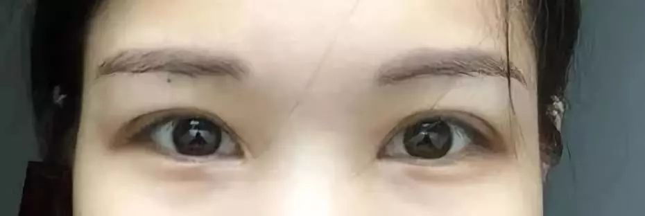 请别再怀疑潘贰做双眼皮手术切肌肉了，希望这是我最后一次澄清