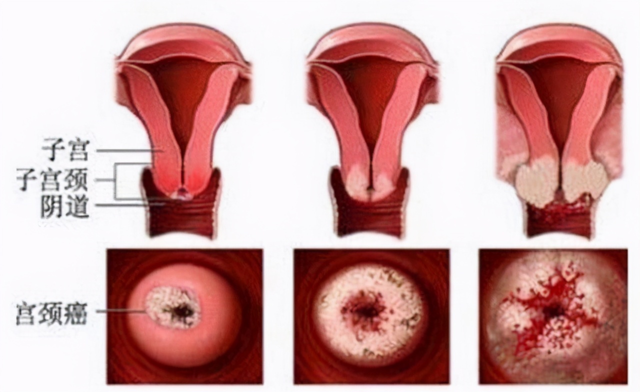 女性宫颈糜烂会影响怀孕吗,宫颈糜烂息肉不孕不育