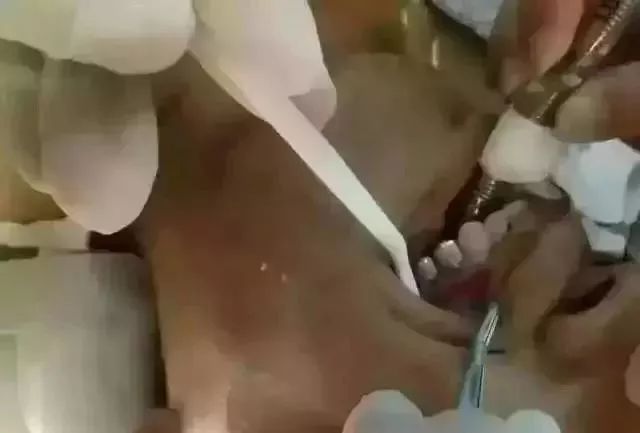 氧化锆全瓷牙的缺点和优点,牙医建议烤瓷不建议全瓷