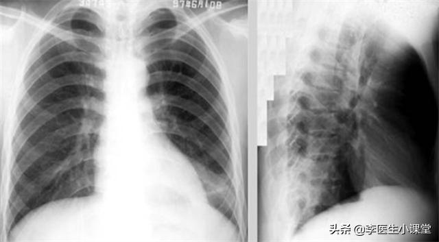 阿莫西林还是阿司匹林不能乱吃,乱吃阿莫西林的后果怎样缓解