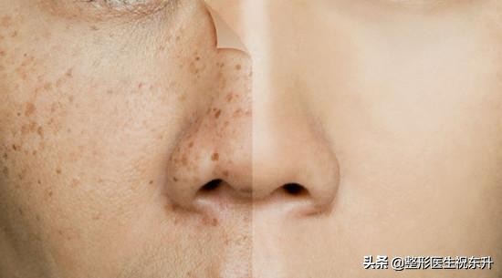 该不该去做皮秒激光手术,皮秒激光到底好不好