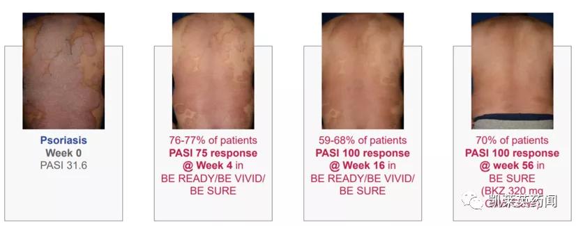 银屑病目前最好的特效药生物制剂,全球最新银屑病新药