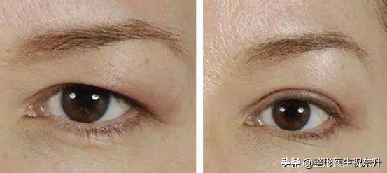 眼皮耷拉除了提眉还有什么办法,眼皮松弛下垂想提眉是需要动刀不