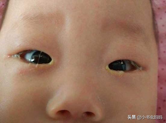 宝宝有眼屎是上火还是湿热,宝宝有眼屎什么原因引起的