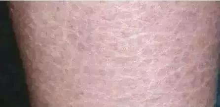 脚后跟老茧怎么去除,我的脚后跟有老茧变硬有细微开裂