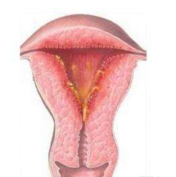 感染反复,ticl晶体植入失败案例