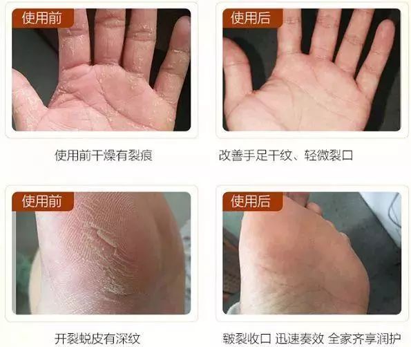 夏天了手脚干裂还有老茧,手脚干裂脱皮老茧用什么药膏